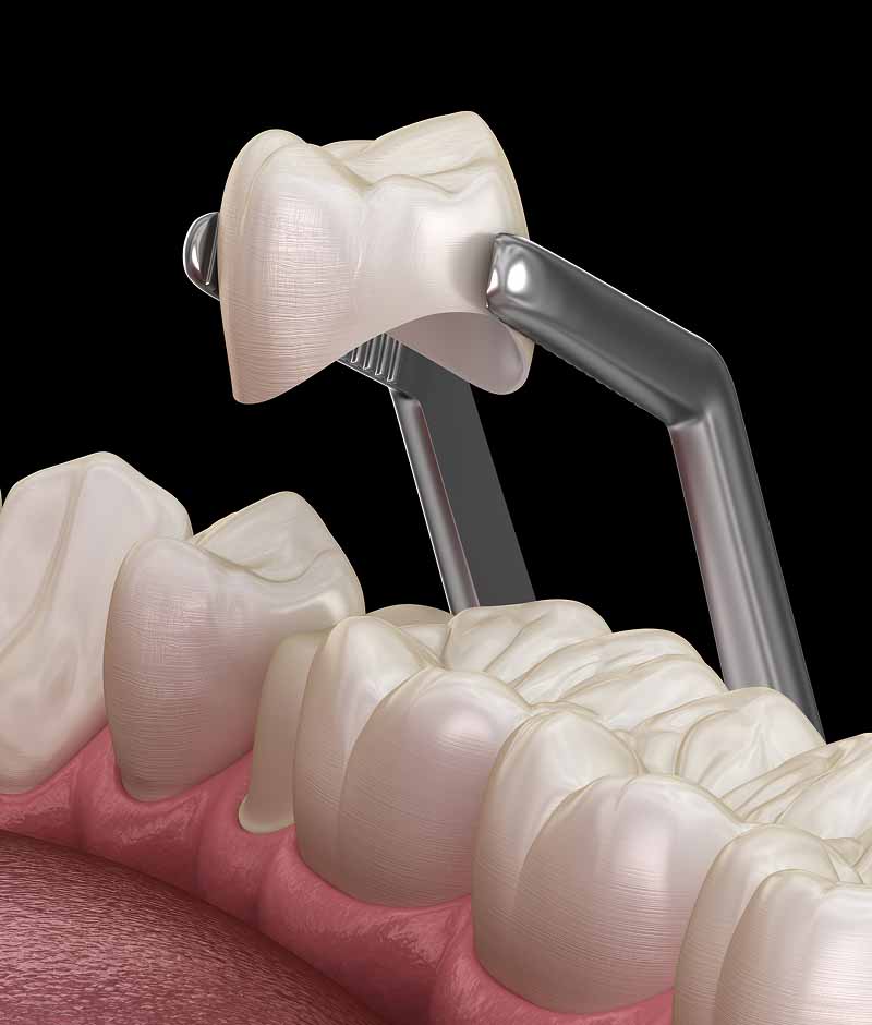 dental crowns Maple Ridge, BC