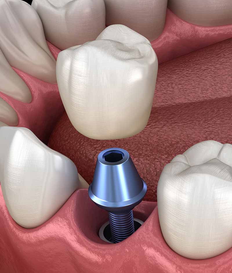 dental implants Maple Ridge, BC