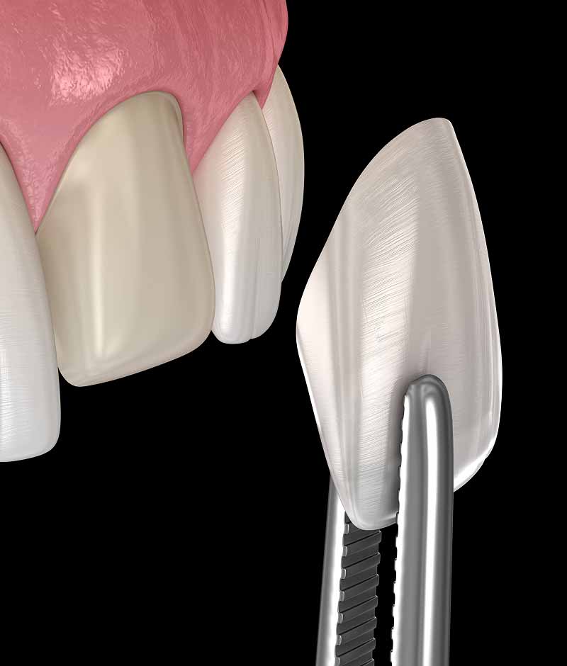 dental veneers Maple Ridge, BC