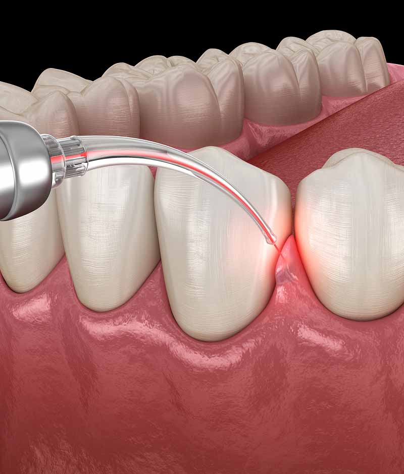 periodontal treatment Maple Ridge, BC