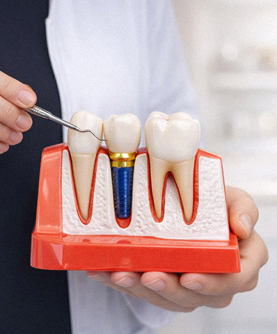 dental implants at Maple Ridge Smiles Dental