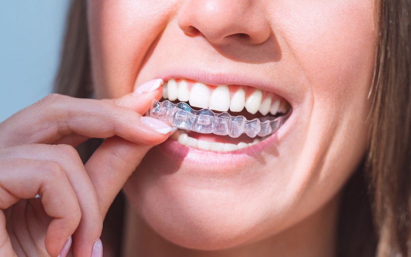 woman with perfect smile-wearing-invisible dental aligners for dental correction